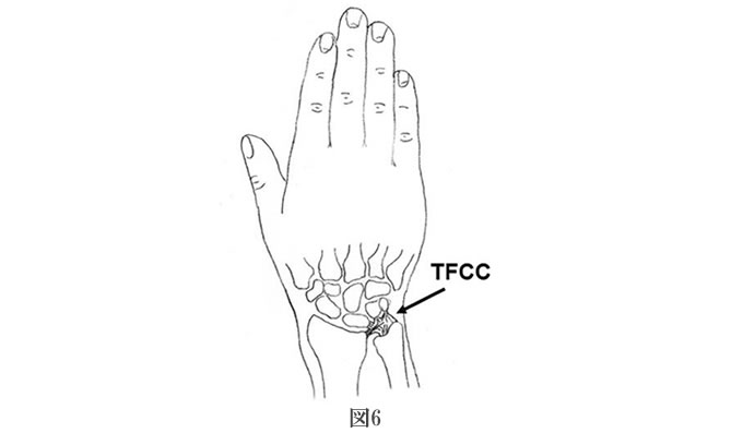 手首の靭帯とTFCCの損傷