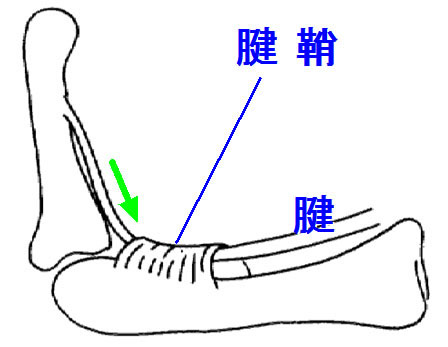 手根管症候群